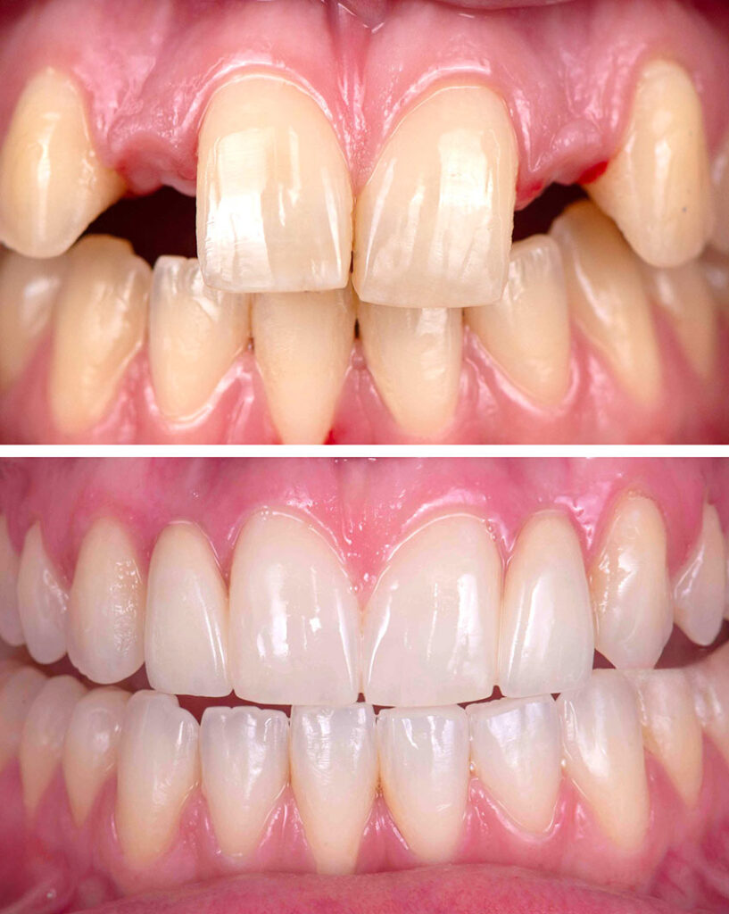 colibri-formation-dentaire-bridges-colles-cantilevers-2