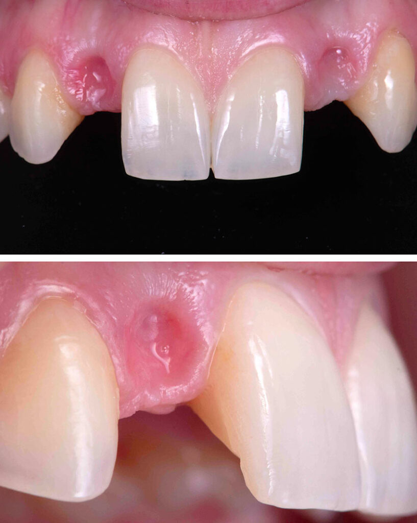 colibri-formation-dentaire-bridges-colles-cantilevers-4