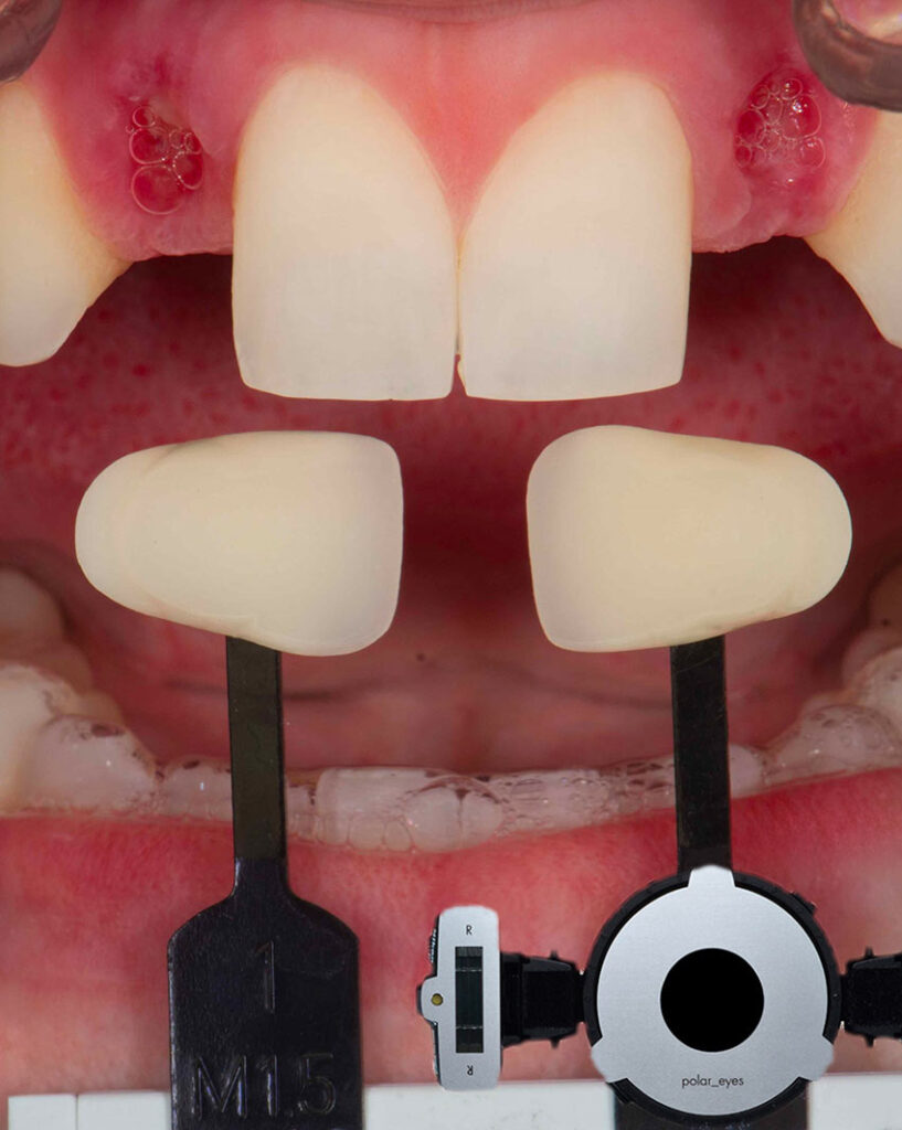 colibri-formation-dentaire-bridges-colles-cantilevers-5