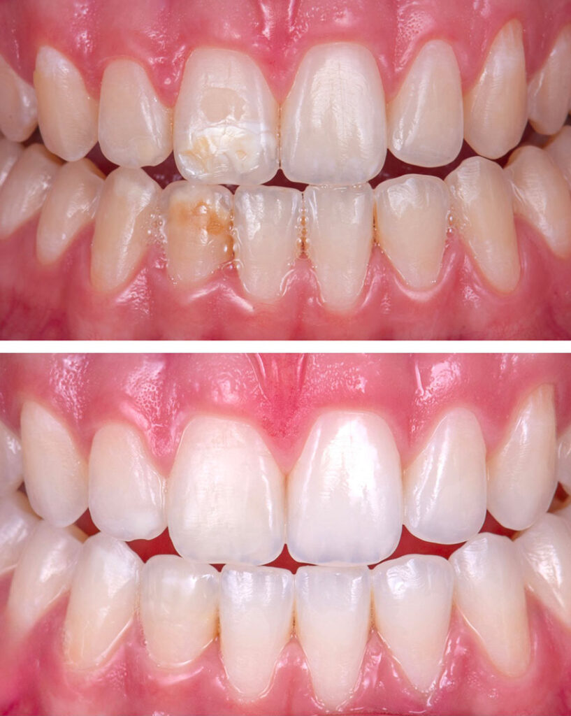 colibri-formation-dentaire-esthetique-ultraconservatrice-2