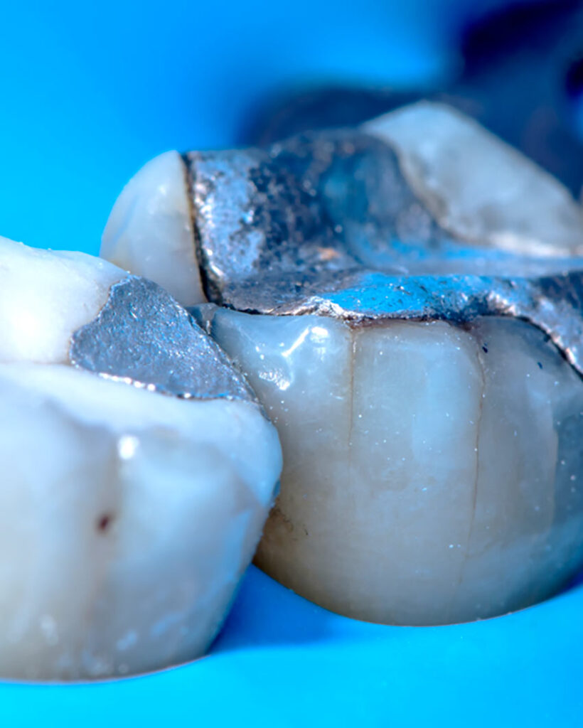 colibri-formation-dentaire-inlays-onlays-overlays-2