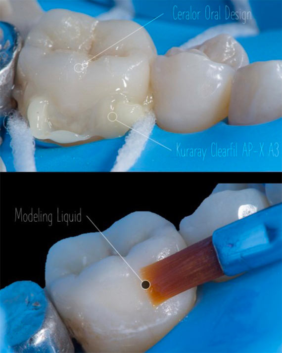 colibri-formation-dentaire-inlays-onlays-overlays-3